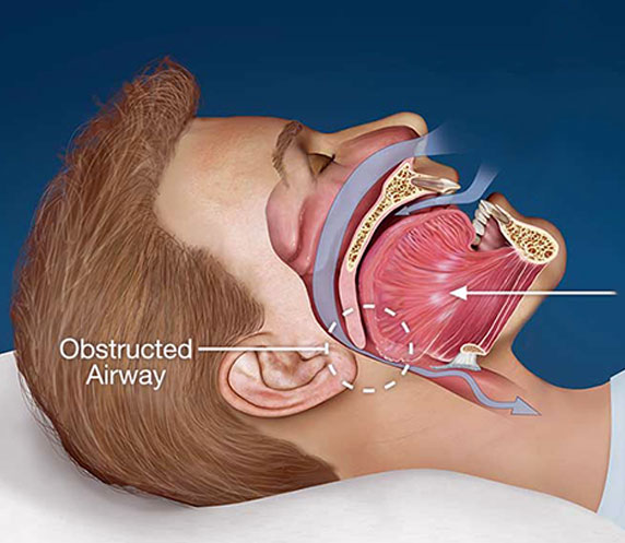 Egent Centers for Ear, Nose and throat. Snoring surgery.