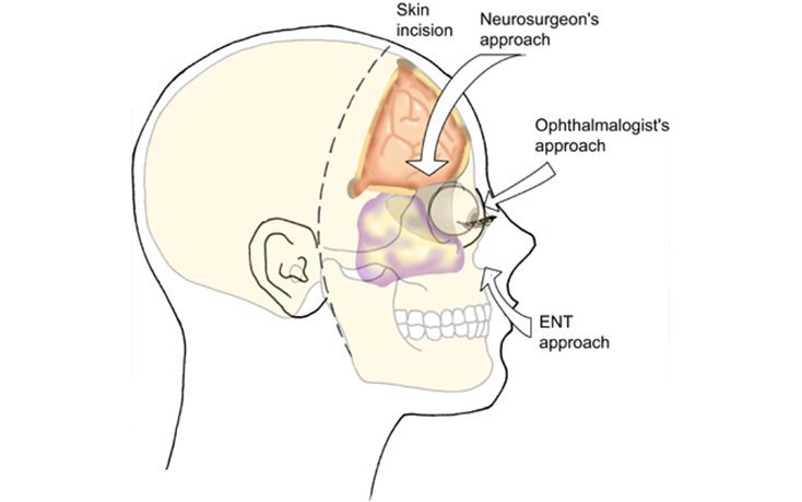 Egent Centers for Ear, Nose and throat. Skull base surgery
