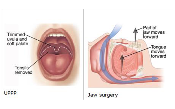 Egent Centers for Ear, Nose and throat. Snoring and Sleep surgery