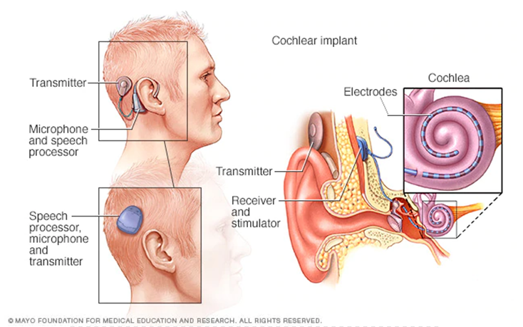 Egent Centers for Ear, Nose and throat. Cochlear implant